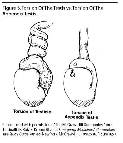 torsion of a testicular appendage